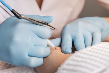 Electrolysis Hair Removal with Needle Probe on Female Arm in Cosmetology Clinic