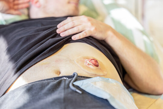 Patient showing simulated colostomy stoma on abdomen during clinical nursing training and medical education