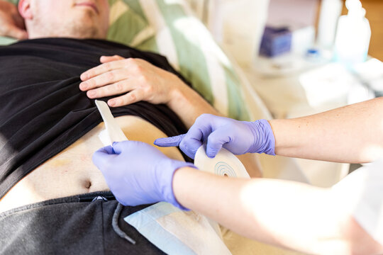 Nurse measuring ostomy baseplate size around patient stoma during ostomy care and medical treatment