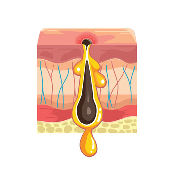 Illustration of Skin Pore Blockage and How a Blackhead forms Process on Skin