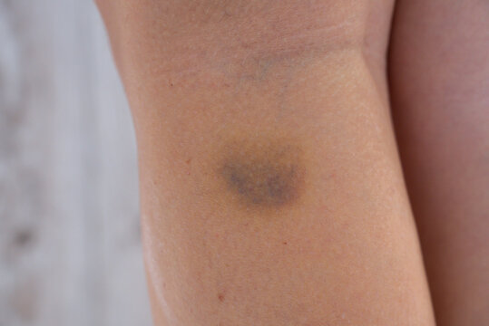Unrecognizable woman with bruise on her leg. Close up of stain bruise wound on leg. Healing injury hematoma blood consequences of sport activity trauma. Extravasation blue purple yellow on skin 
