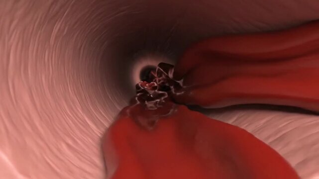 Arterial Vasoconstriction &ndash; Narrowed Blood Vessel Lumen Medical 3D Visualization