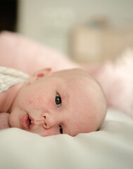 A tender portrait of a newborn baby with skin adaptation rash and tiny red spots. The baby is resting on white fabric, embodying purity, tranquility, and the natural process of early skin changes.