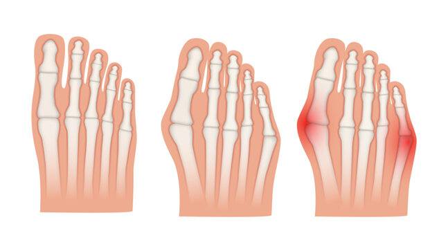 Hallux valgus. Valgus deformity of the big toe and little toe joint. Vector illustration.