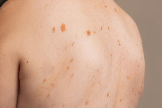Close-up of an elderly woman's back showing multiple pigmented lentigo spots, age-related skin changes, with natural skin texture.