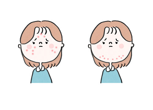 omparison of a worried woman with teenage acne and adult acne, skincare concept