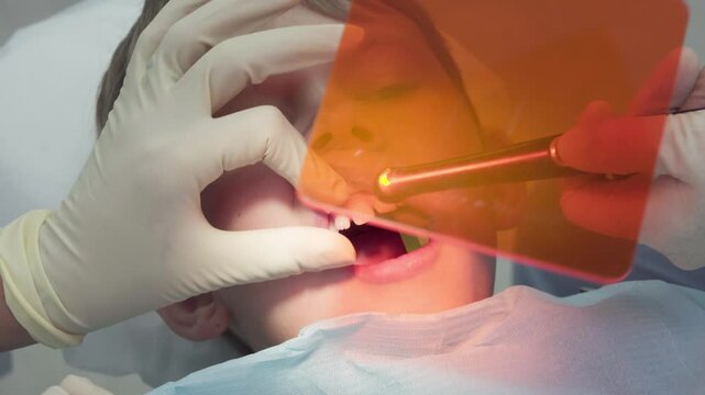 Dentist repairs the boys chipped tooth with glue. Assistant uses ultraviolet light to cure filling composite, ensuring a strong bond and quick fix
