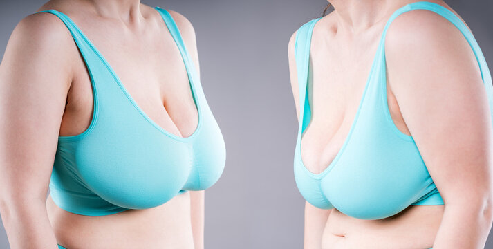 Before and after of curvy woman with large breasts, bad and good posture, concept of kyphosis, back pain and orthopedic correction