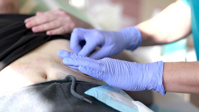 Nurse applies skin barrier ring on stoma model during ostomy care training in clinical education setting