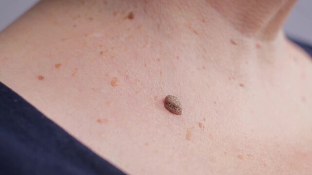 A large mole or papilloma on the cervical skin of an elderly woman, close-up