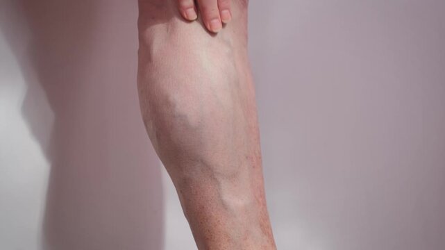 An elderly woman with varicose veins stretches her leg