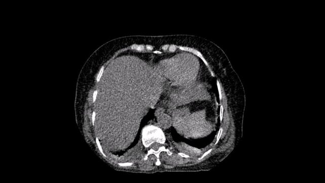 An ectopic kidney,abdomen ct scan
An ectopic kidney, also known as renal ectopia, is a congenital renal anomaly characterized by the abnormal location of one or both of the kidneys. Computed tomograp
