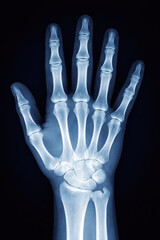 Human hand X-ray showing skeletal anatomy and bone structure