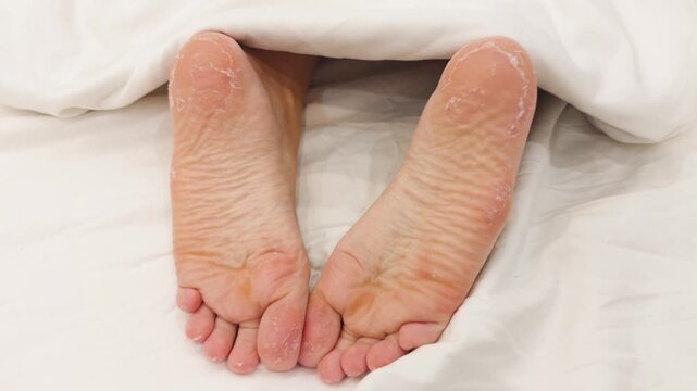 Feet with dry and peeling skin, indicative of dermatological issues such as xerosis, calluses, or fungal infection, showing rough texture on heels and soles against white bedding