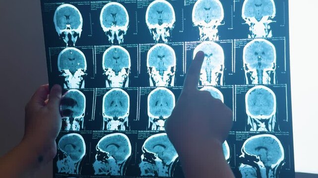Hands holding and pointing at a medical ct scan image showing multiple axial and sagittal views of a human brain, demonstrating professional medical analysis and diagnosis process