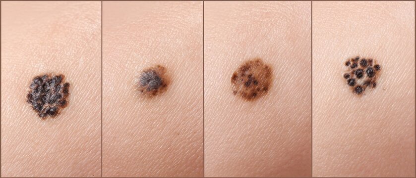 A detailed four-panel sequence showing the evolution and varying appearance of malignant melanoma moles on human skin for medical diagnosis.