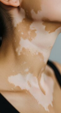 Close up of vitiligo skin condition on neck and shoulder, detailed dermatology texture showing pigmentation loss and melanin contrast, medical awareness and inclusive beauty concept