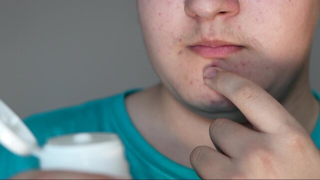 Teen guy with acne problem applying cream on light background, closeup