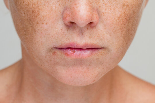 Cropped female face with herpes simplex virus