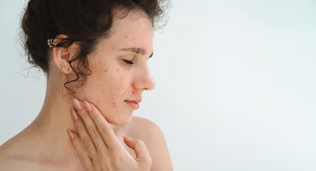 portrait of a young teenage girl with pimples and acne on problematic facial skin. Face of adult woman with bad inflamed skin in close-up on a white isolated background © alexkoral