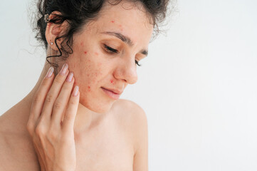 portrait of a young girl with pimples and acne on problem facial skin. Face of adult woman with bad red inflamed skin and acne on a white isolated background