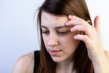 Naklejka premium A young girl with acne or pimples on her face on a gray background