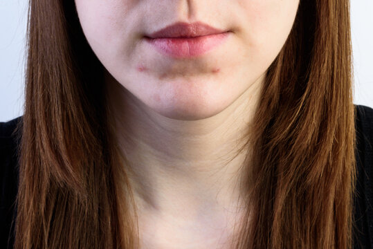 A young girl with acne or pimples on her face on a gray background