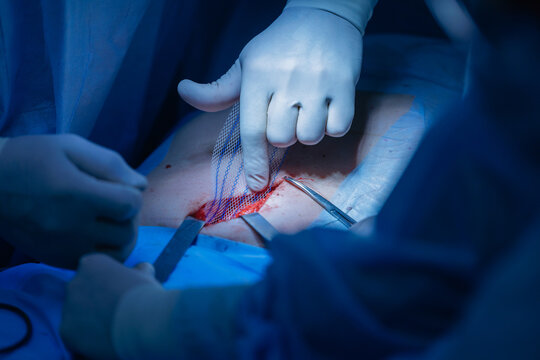 Surgical procedure with mesh after umbilical hernia removal, hands in blue gloves performing abdominal operation