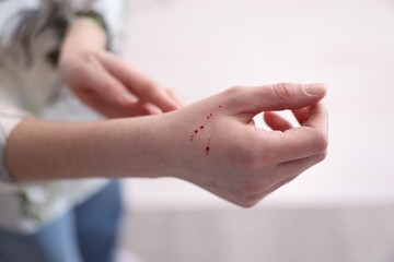 Woman with cat scratches on blurred light background, closeup