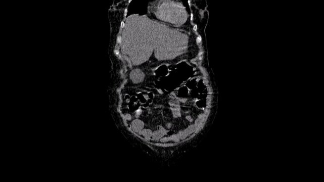An ectopic kidney,abdomen ct scan
An ectopic kidney, also known as renal ectopia, is a congenital renal anomaly characterized by the abnormal location of one or both of the kidneys. Computed tomograp
