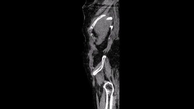 An ectopic kidney,abdomen ct scan
An ectopic kidney, also known as renal ectopia, is a congenital renal anomaly characterized by the abnormal location of one or both of the kidneys. Computed tomograp

