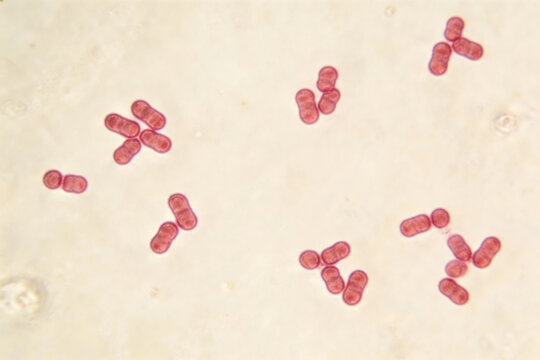 Micrograph of Haemophilus influenzae bacteria, small pleomorphic coccobacilli in short chains, Gram stain style of clinical sample (cerebrospinal fluid)