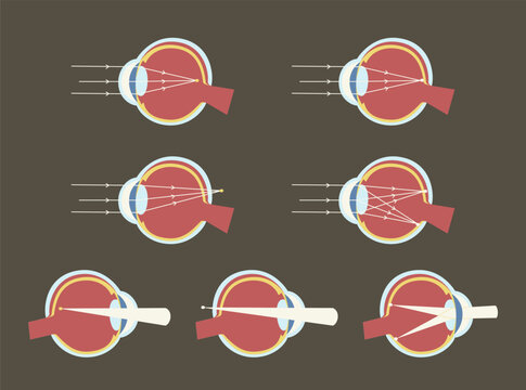 Vision Defects Myopia Hyperopia Astigmatism Eye Anatomy Illustration Set