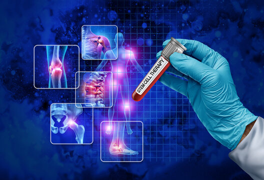 Stem Cell Therapy Concept donation and human regenerative treatment donating stem cells as Regenerative Medicine as Mesenchymal Cells in a test tube with a Doctor or researcher holding a glass contain