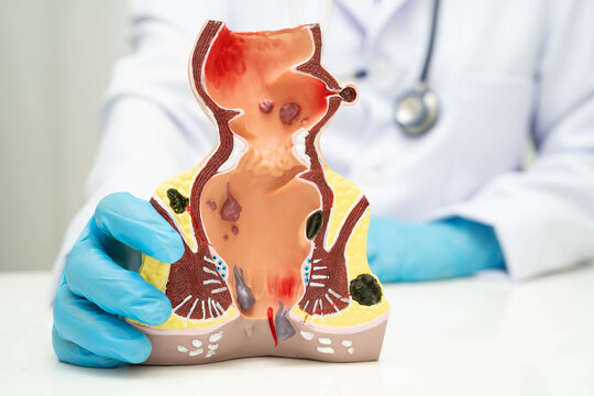 Asian doctor with rectum and hemorrhoid human anatomy model at hospital, inflamed vascular structure.
