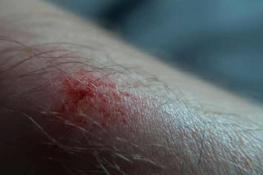 Stage one bedsores appear as red irritated skin on surface often caused by prolonged pressure and can be painful if not treated early in healthcare or home setting