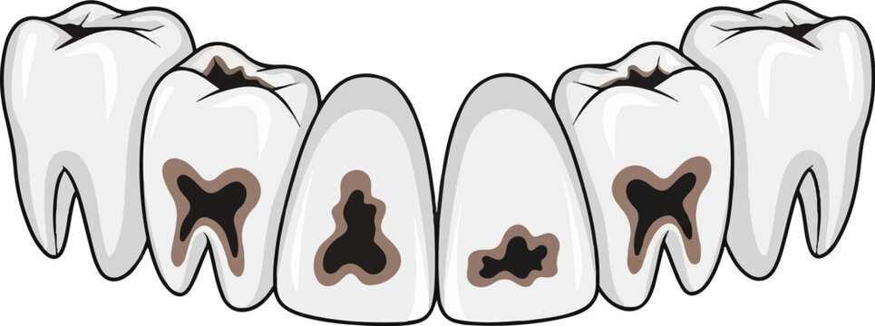 Row of white molars with visible dark decay and cavities