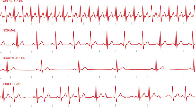 ECG heartbeat waveform comparison chart, tachycardia normal rhythm bradycardia and irregular heartbeat electrocardiogram medical diagnostic monitoring illustration