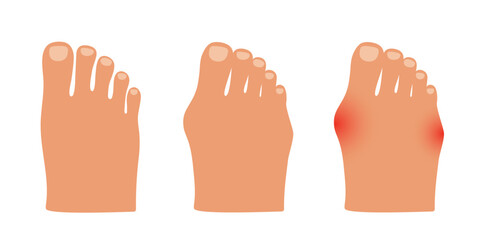 Obraz premium Hallux valgus of the little toe and big toe. Valgus deformity of joint. Vector illustration.