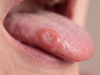 Obraz premium Close up of tongue ulcer showing oral health problem