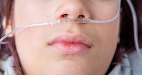 teenager male Patient with oxygen nasal cannula, respiratory support therapy, breathing assistance...