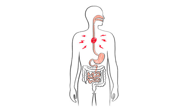 Esophagus pain diagram