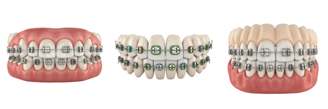 Set of 3D human jaws with metal and ceramic dental braces isolated on white background, concept of orthodontics, teeth alignment and stomatology.