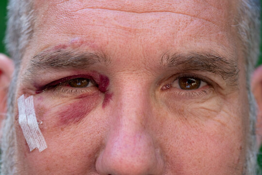 Close-up of man with black eye
