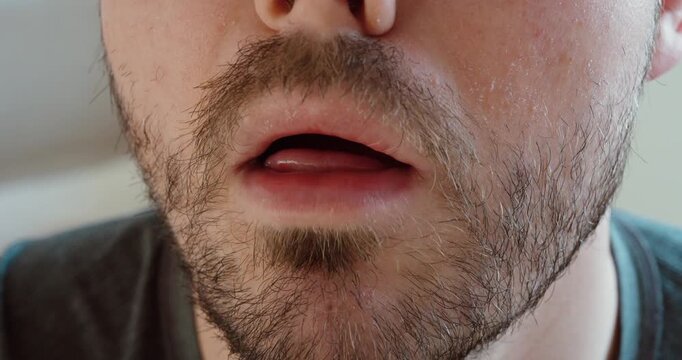 Close-up macro shot of a man's mouth showing a swollen tongue caused by an allergic reaction. Visual representation of allergy symptoms, oral inflammation, and possible medical emergency.