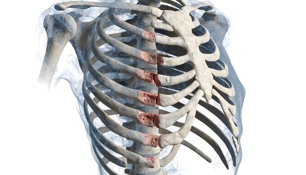 3D medical illustration of a human rib cage in an oblique view, highlighting a mid-rib fracture with a red trauma zone. Features translucent intercostal muscles and lungs on a white background.