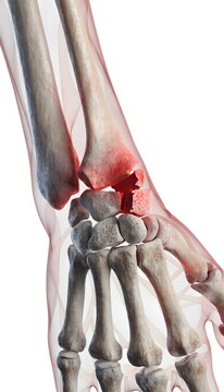 3D medical illustration of a human wrist with a distal radius and scaphoid fracture. Skeletal structure with red injury highlights and translucent soft tissue on a white background.