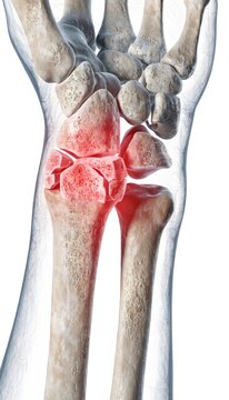 3D medical illustration of a human wrist with a distal radius and scaphoid fracture. Skeletal structure with red injury highlights and translucent soft tissue on a white background.