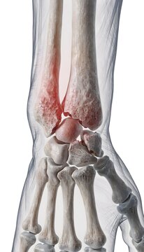 3D medical illustration of a human wrist with a distal radius and scaphoid fracture. Skeletal structure with red injury highlights and translucent soft tissue on a white background.