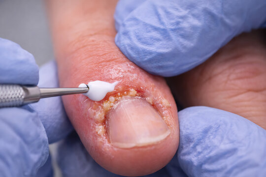 Close Up Medical Treatment of Infected Fingernail With Instrument for Dermatology Procedure and Wound Care Management